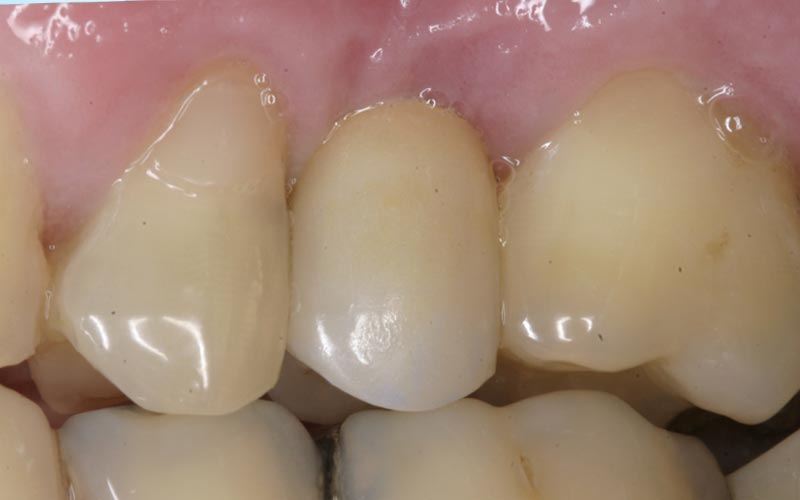 ferige Implantatkrone im Mund