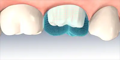 Prophylaxe